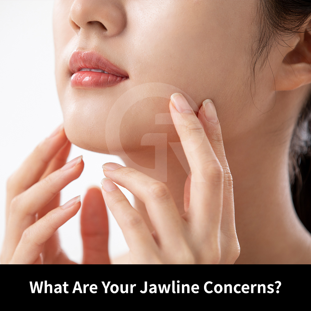 Blurred jawline caused by soft tissue volume rather than bone structure