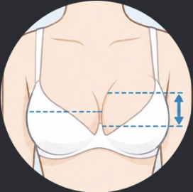 乳房不对称
