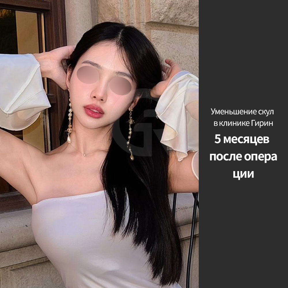 В Girin Plastic Surgery уменьшение скул планируется так, чтобы сохранить объемность лица и улучшить его контур.