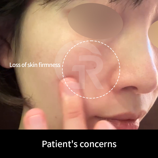 Collagen plays a key role in supporting pore structure and maintaining skin density.