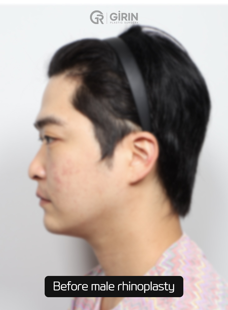 Specialized Korean clinic for male hump nose correction.