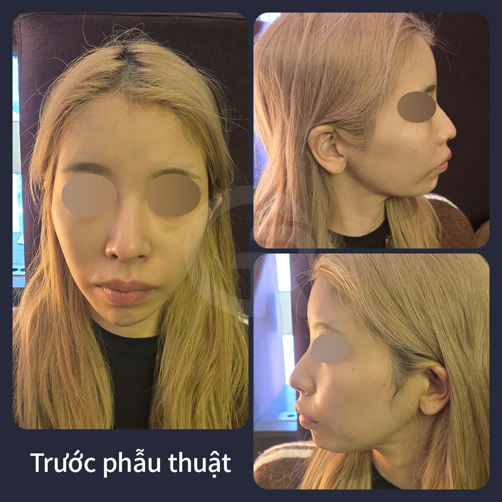 Tại Girin Plastic Surgery ở Seoul, Hàn Quốc, phẫu thuật tạo hình đường nét khuôn mặt và cấy mỡ có thể được cân nhắc khi phẫu thuật hai hàm không phù hợp vì lý do an toàn.