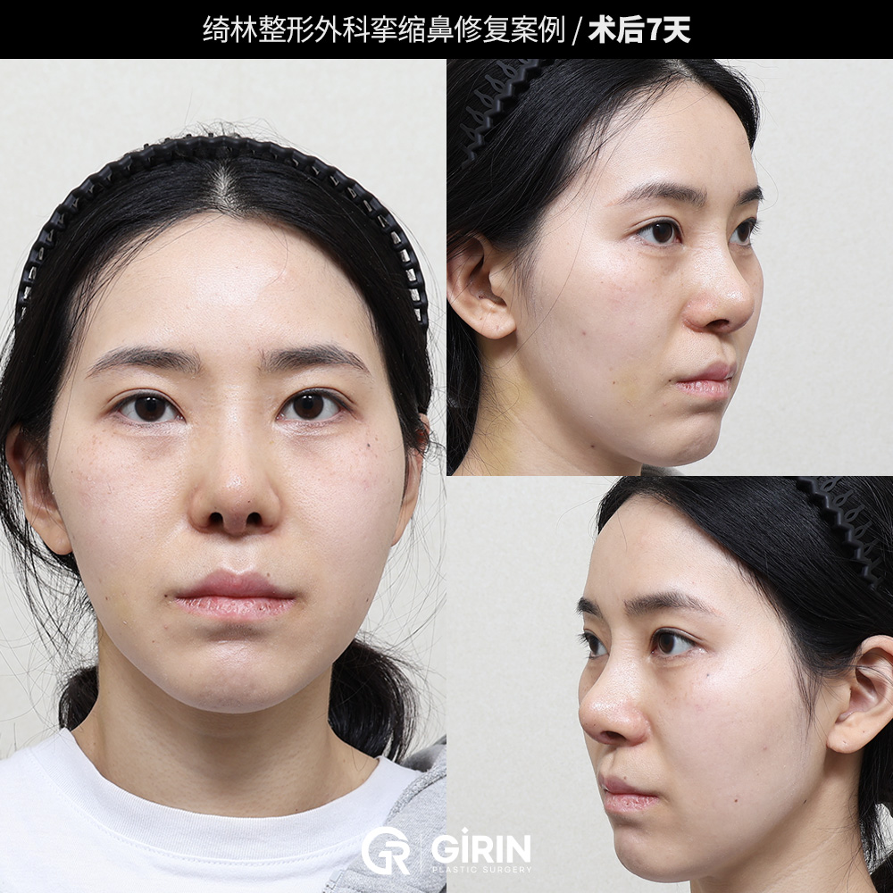 首尔鼻修复手术一对一咨询场景