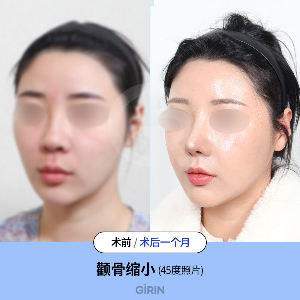 韩国3D颧骨缩小术概论（完整中脸结构指南） : Blog