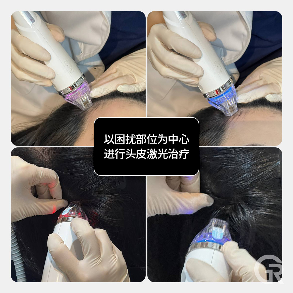 微针射频头皮管理