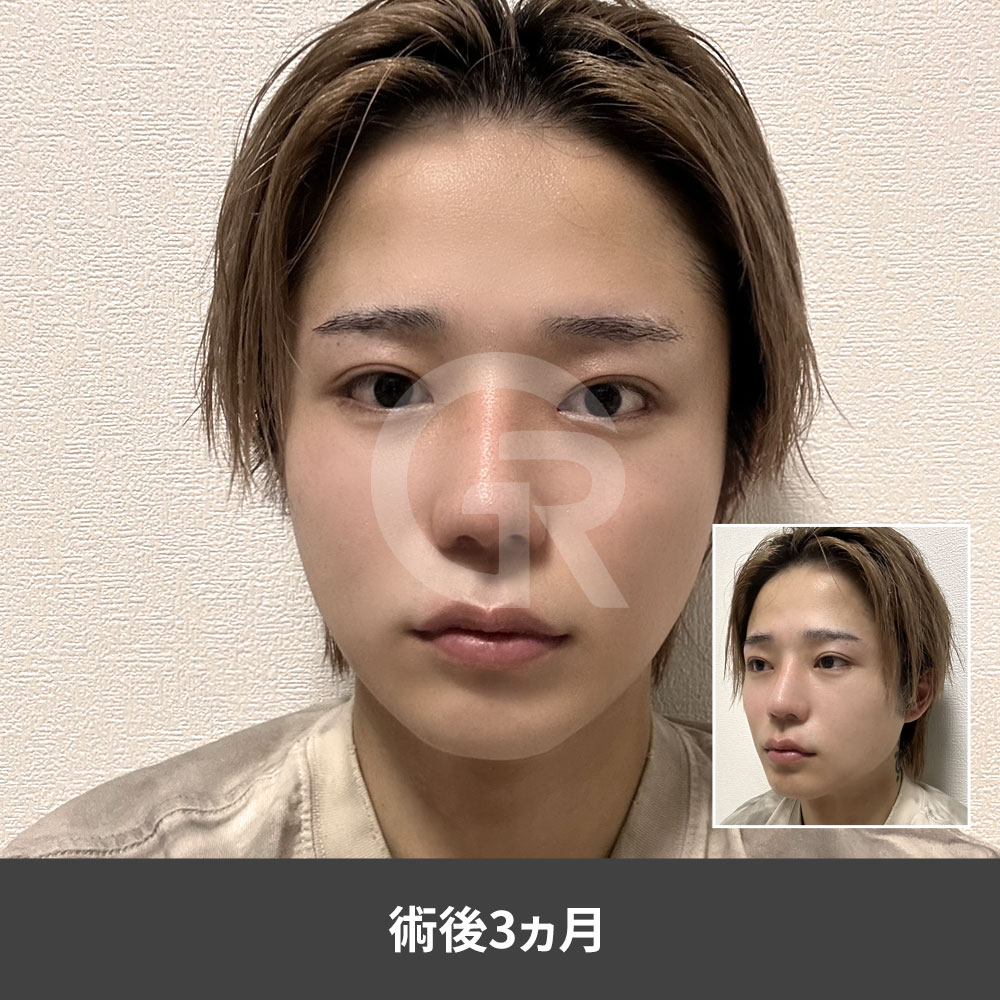 自然な男性Vライン輪郭形成では、単に骨量を減らすのではなく、安全な範囲で顔全体のラインを整えることが重要です。