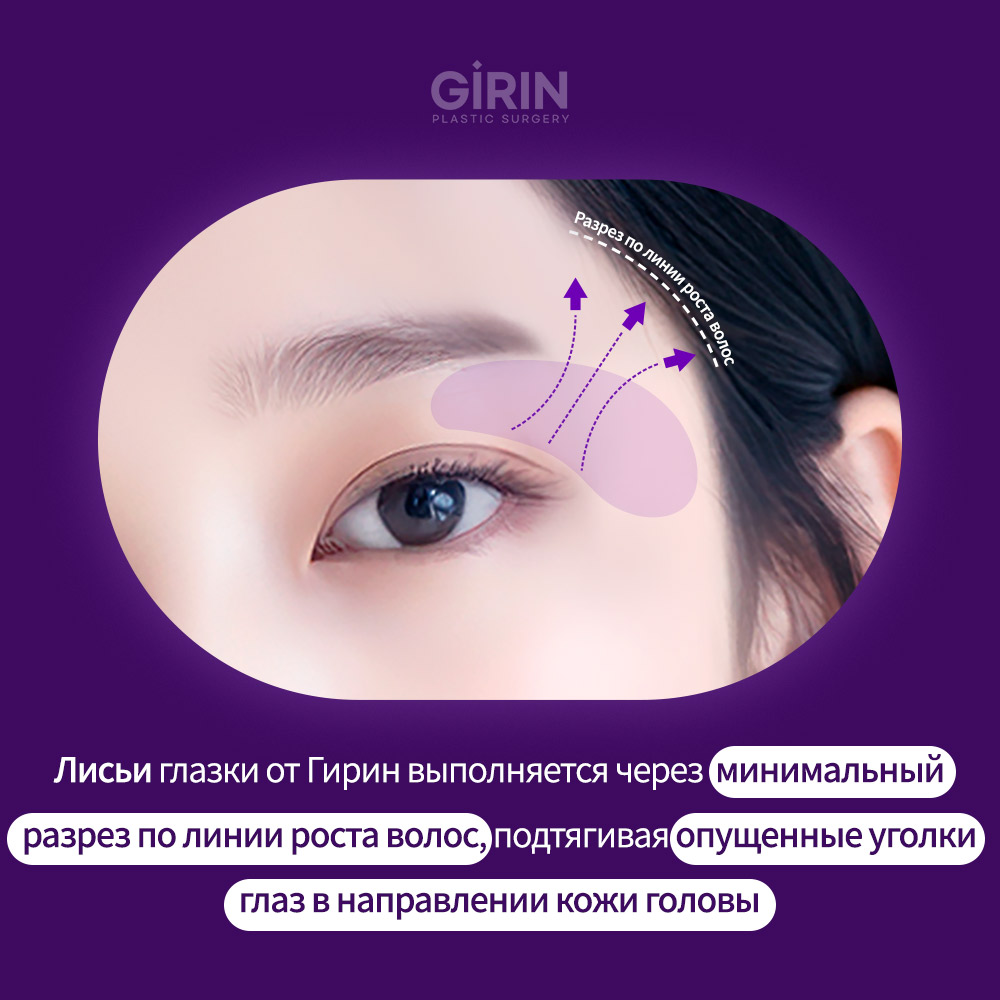 Мини-разрез в линии роста волос, шрам незаметен.