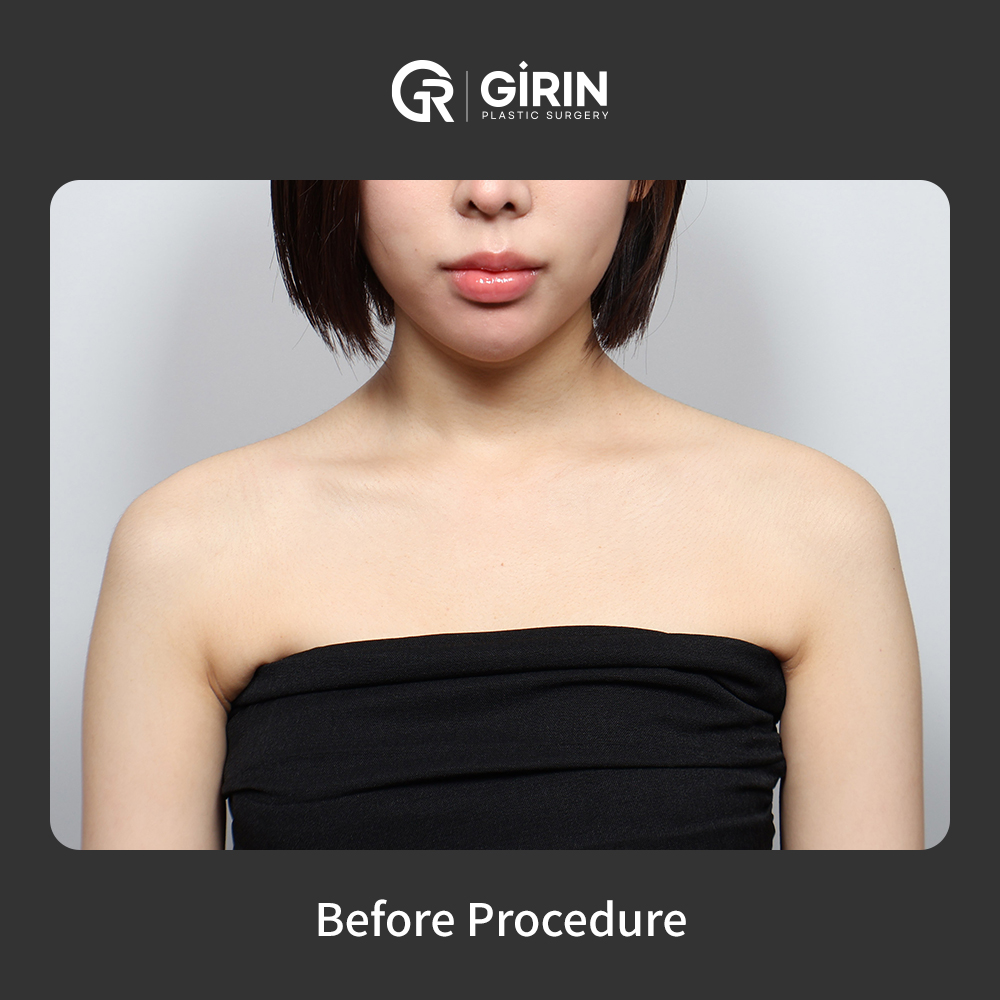 Transform your shoulder silhouette instantly with Korea's trending filler treatment