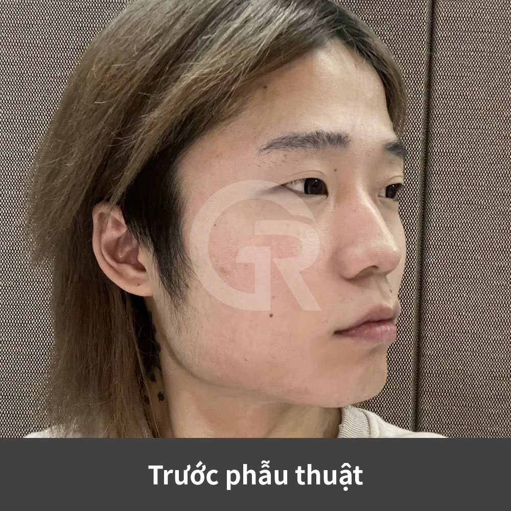 Phẫu thuật thẩm mỹ nam tại Hàn Quốc ngày càng chú trọng sự cân bằng tự nhiên của khuôn mặt thay vì tạo ấn tượng nam tính quá mạnh hoặc thiếu tự nhiên.