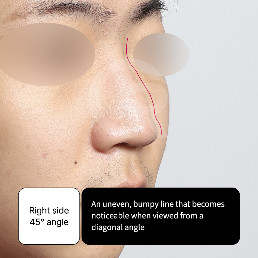 Postoperative structural change after male rhinoplasty at GIRIN PLASTIC SURGERY in Korea.