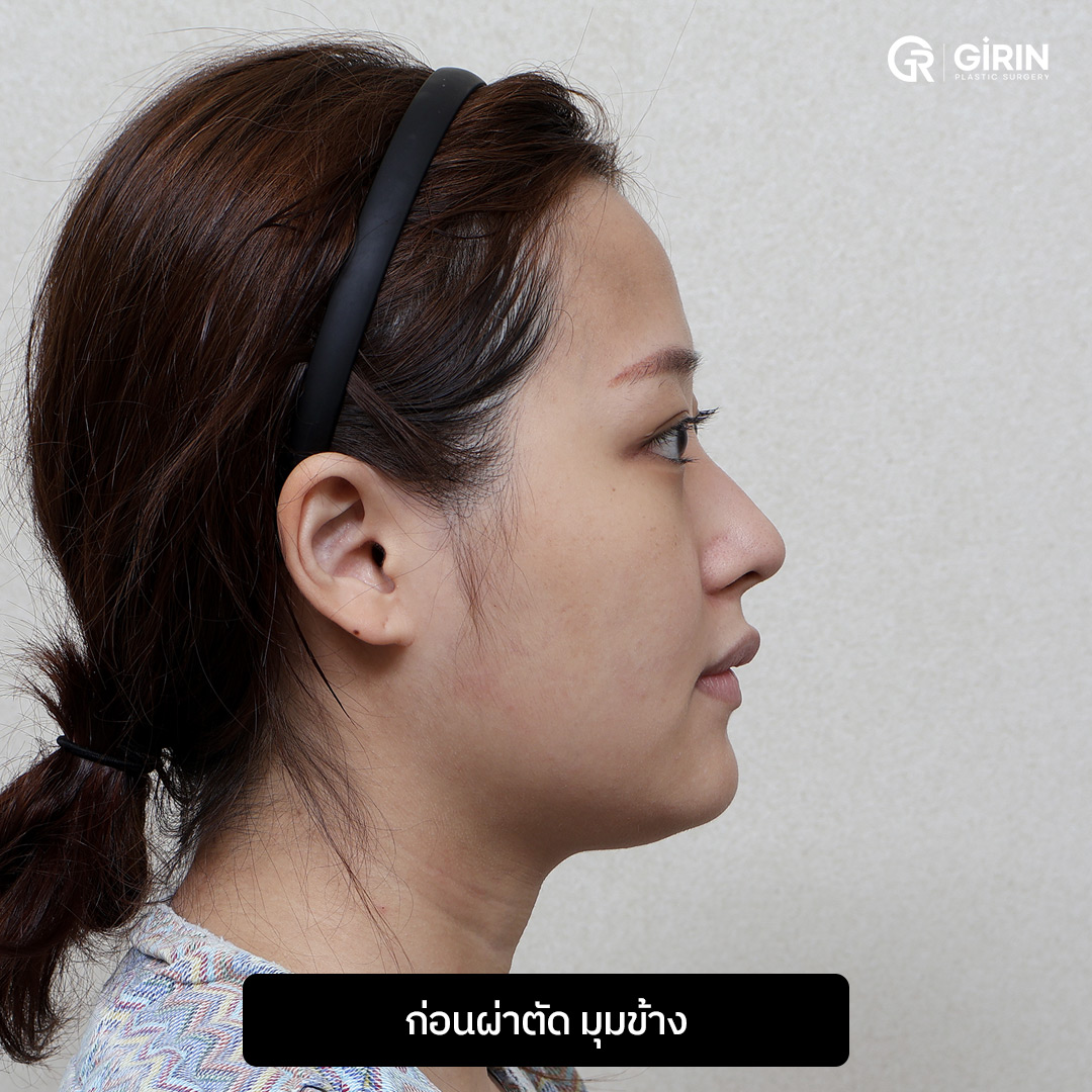 ยึดกระดูกมั่นคง พร้อมปรับสัดส่วนใบหน้าให้สมดุล