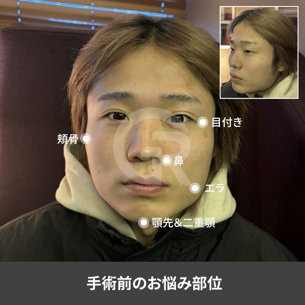 韓国での男性フルフェイス整形では、目・鼻・フェイスライン・輪郭を整えながら、もともとの雰囲気を保つことができます。