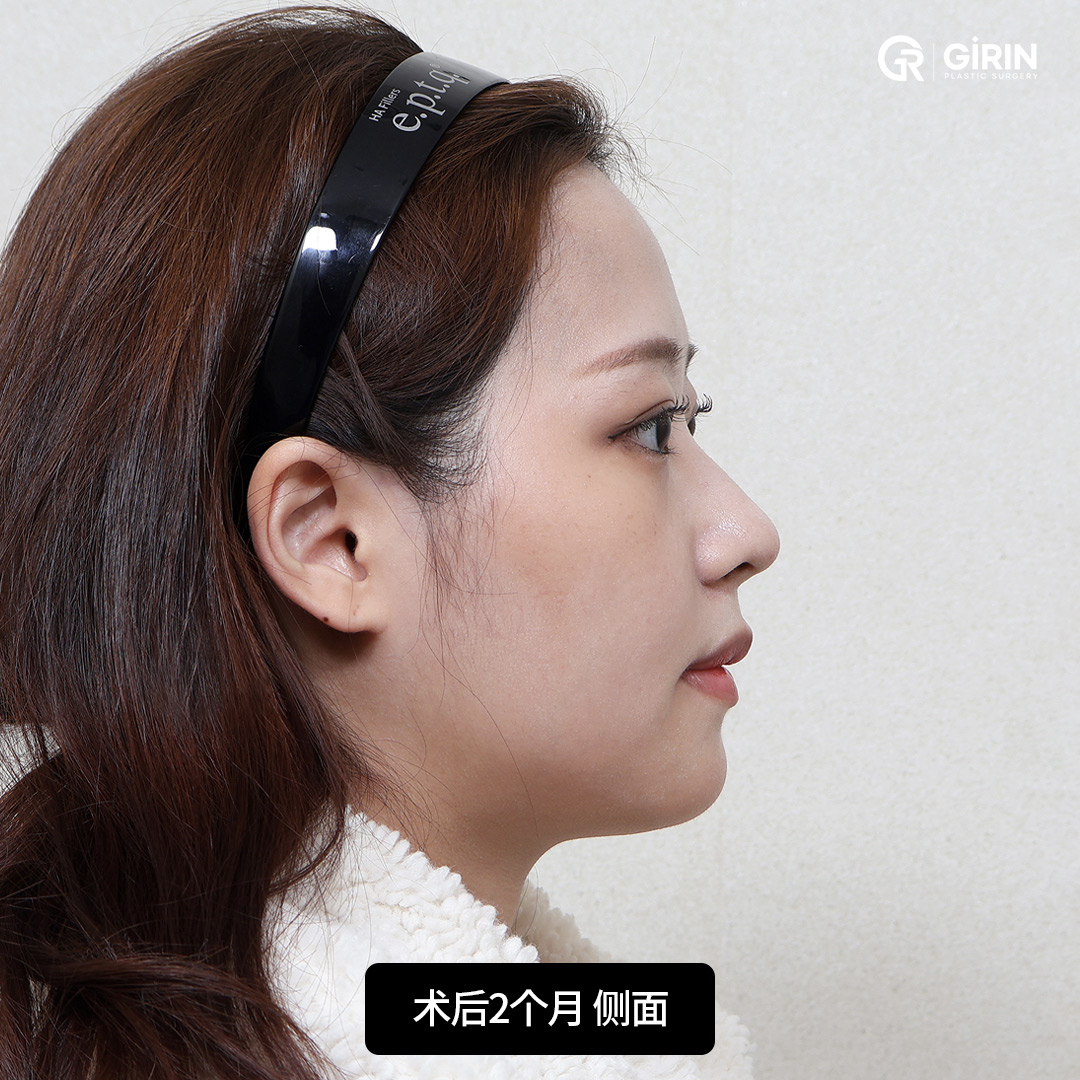 韩国SSRO手术带来自然之美