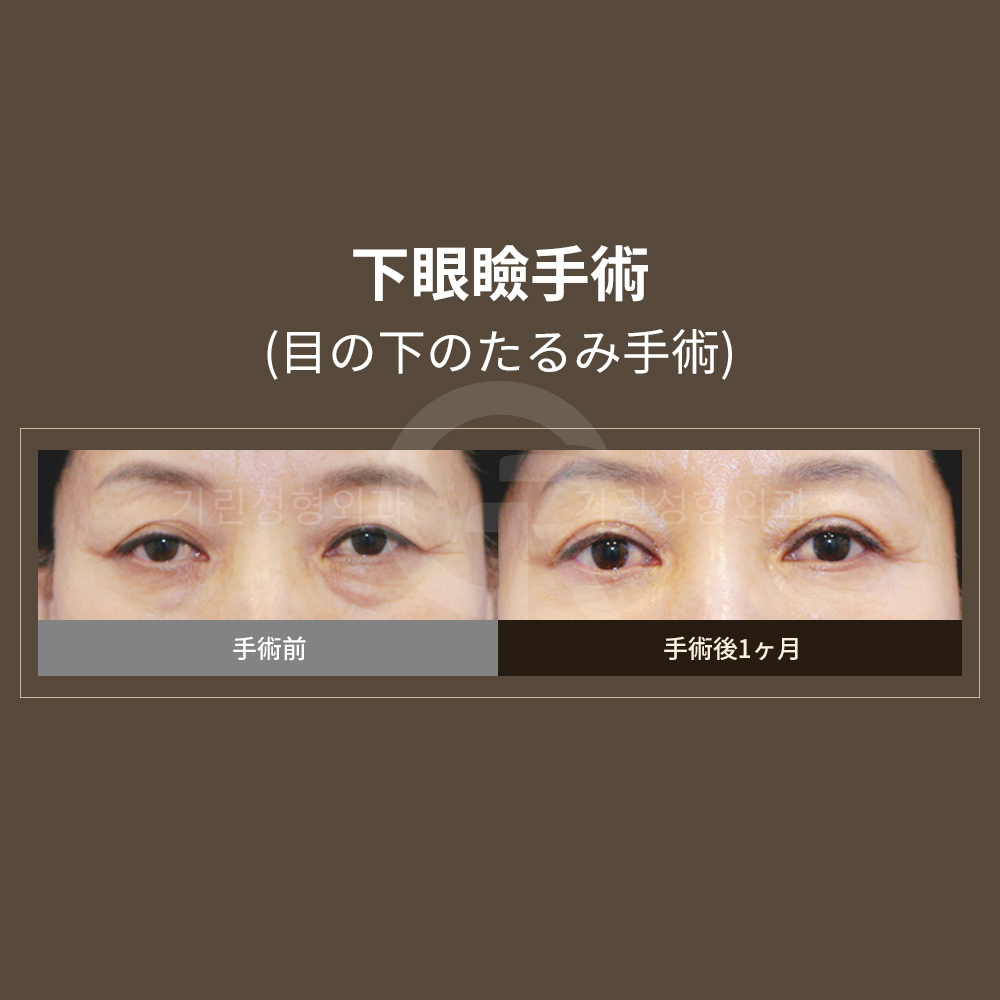 額リフトは目元だけでなく、額のしわ改善にも効果があります。