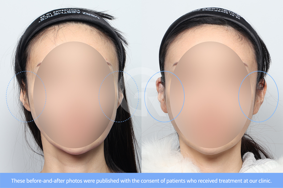 The helix and antihelix structures play an important role in determining the natural contour of the ear.
