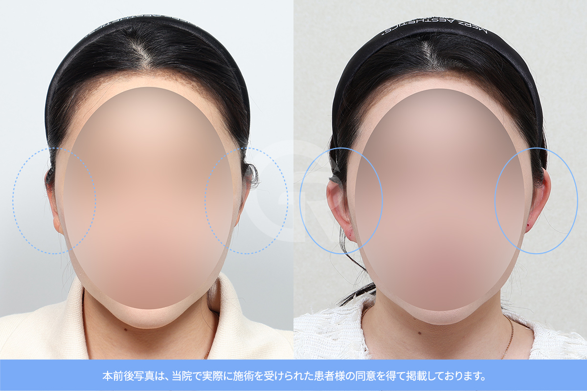 韓国の耳整形は自然な仕上がりを重視した繊細なデザインが特徴です。