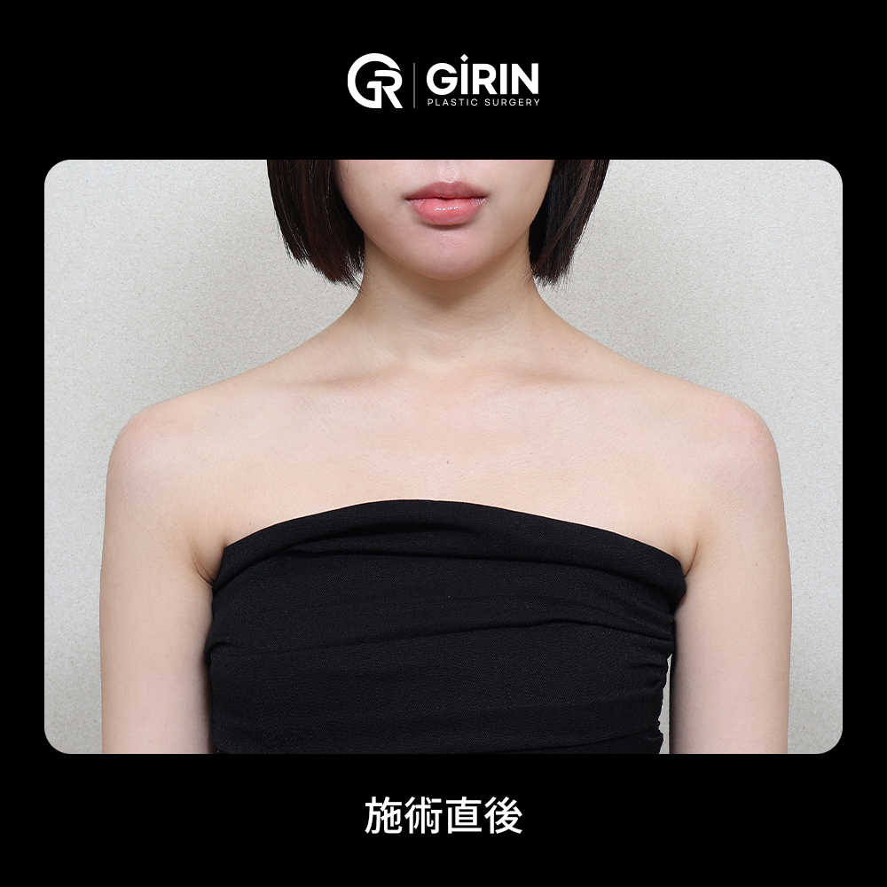 顔が小さく見える肩ラインの変化