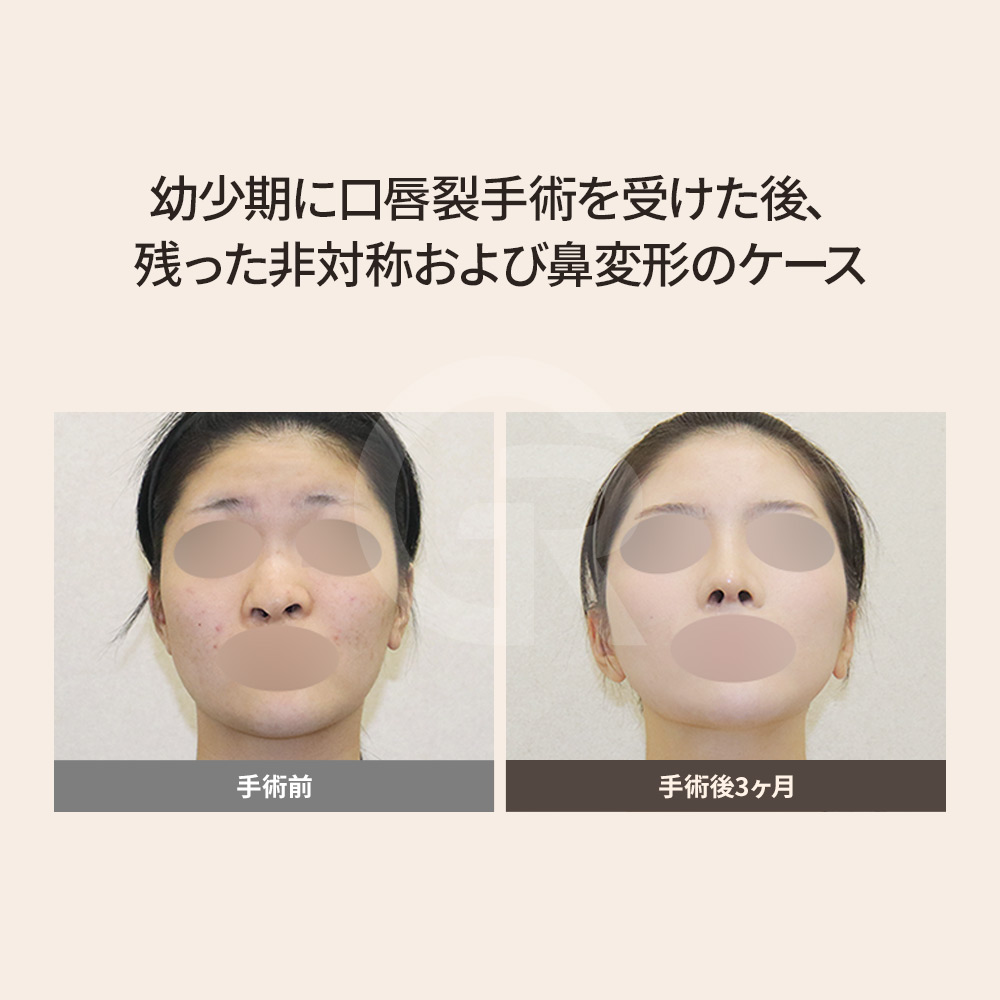 口唇口蓋裂に伴う鼻中隔偏位の矯正、ソウルの専門クリニック。