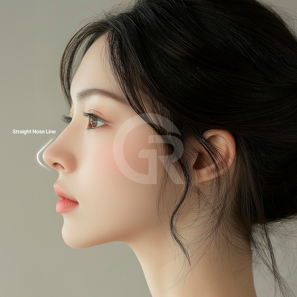 Bulbous nose correction without silicone can be planned according to cartilage, skin thickness, and elasticity.