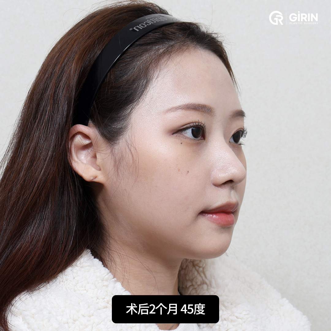 笑容恢复对称与自信