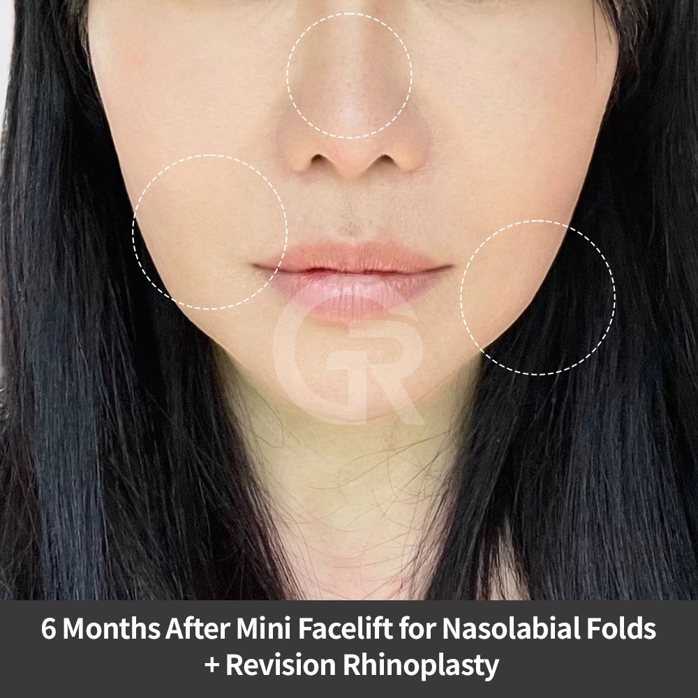 A surgical review from Girin Plastic Surgery in Gangnam, Korea, including mini facelift, revision rhinoplasty, and anti-aging facial improvement.