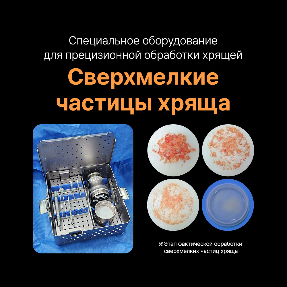 Ринопластика без имплантов в Сеуле