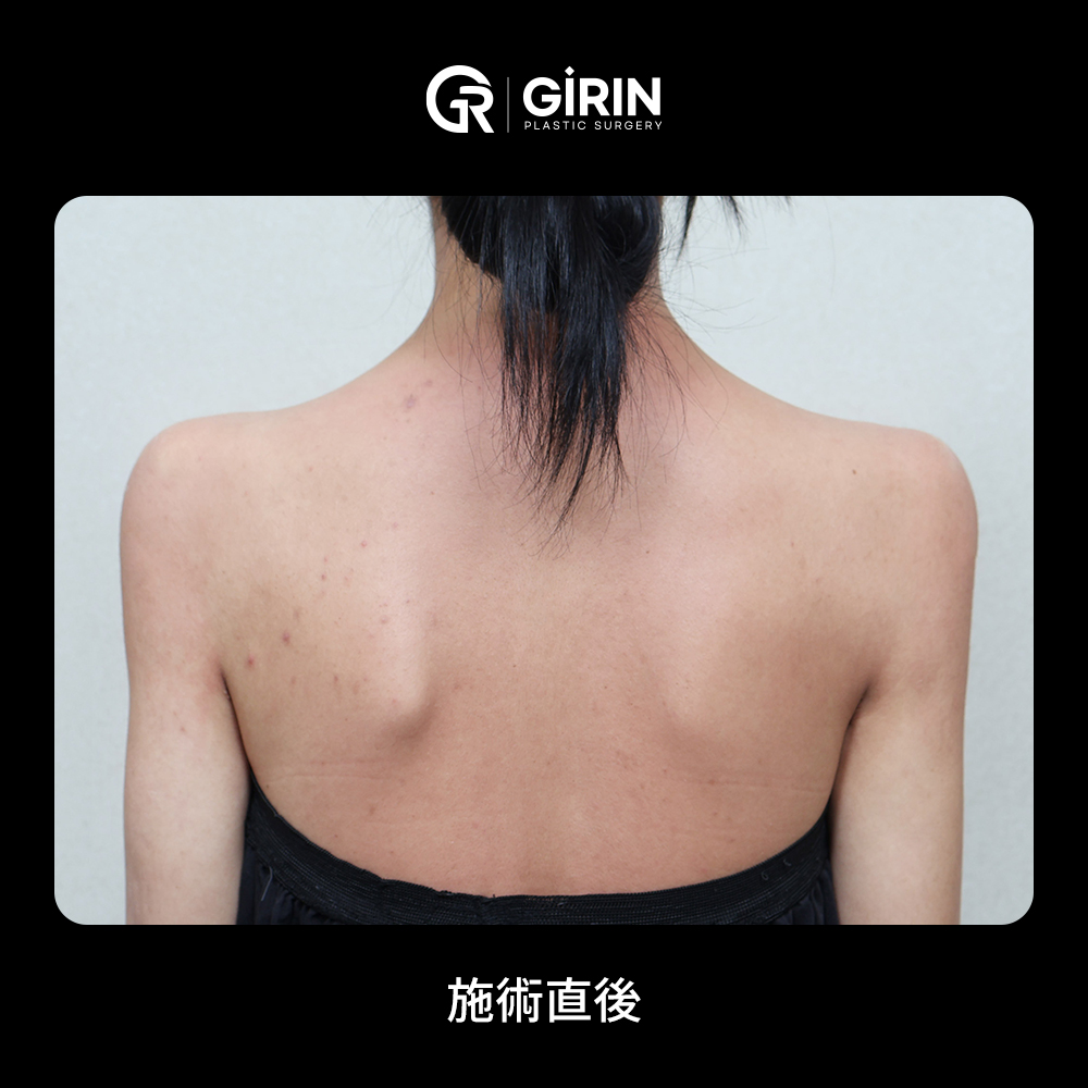 肩の内巻きを修正した症例