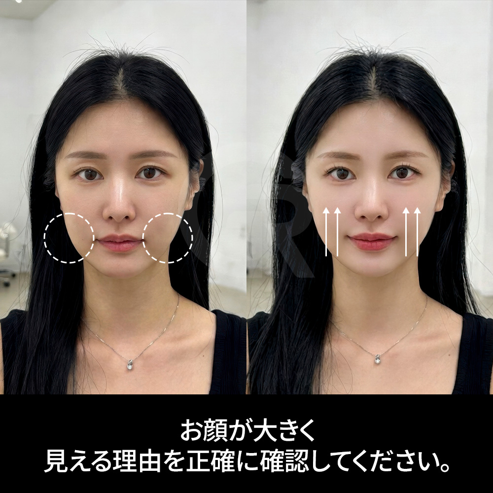 日本人患者にも適した自然な小顔デザイン