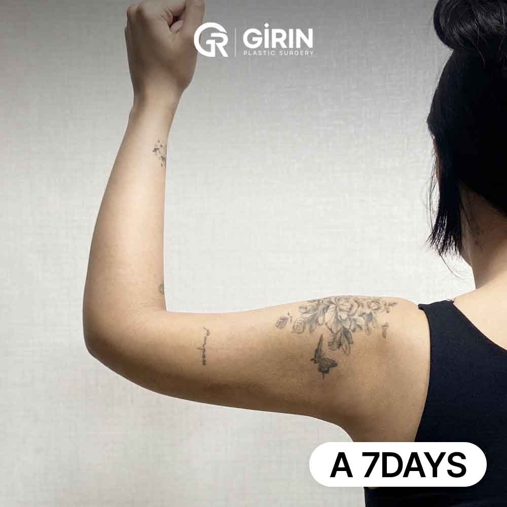 Stubborn upper arm fat can be resistant to exercise