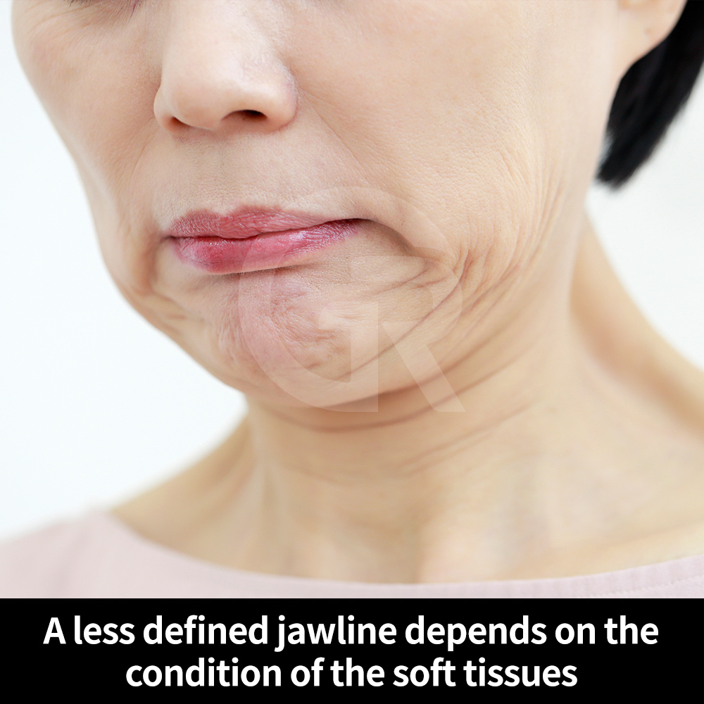 Structural analysis of double chin including fat and muscle layers