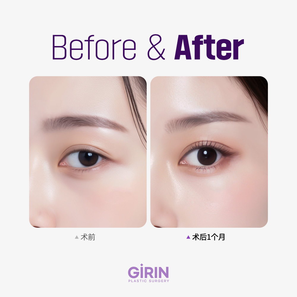 绮林整形外科狐狸眼提拉术前咨询场景。