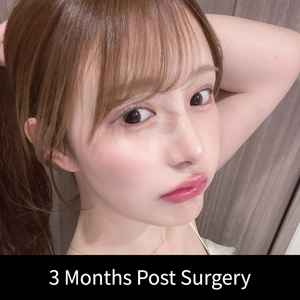 The goal of Winter nose rhinoplasty is to create a soft, feminine nasal line that suits each patient’s individual facial features.