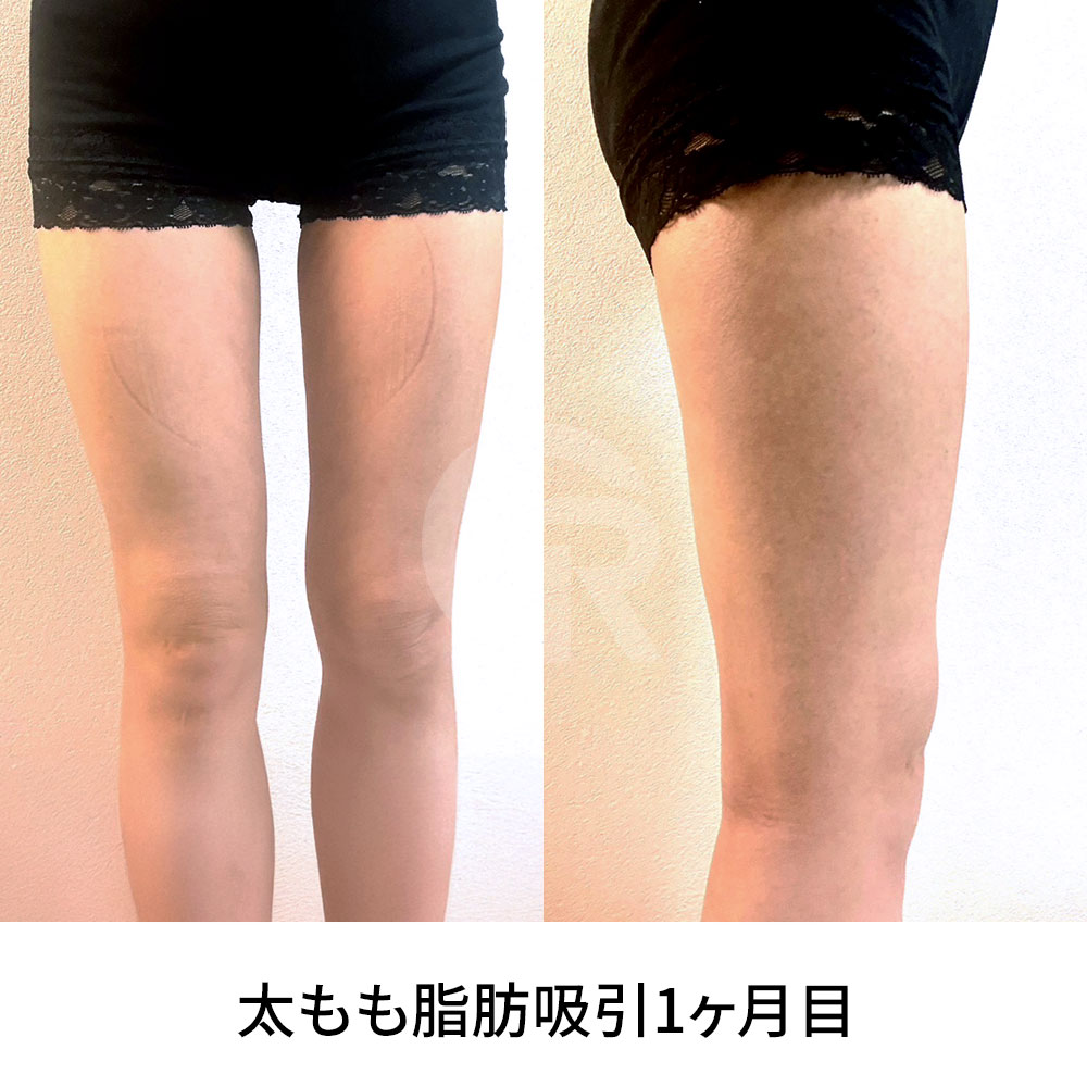 太ももの隙間だけを手術の目標にするのではなく、自然で調和の取れたバランスが大切です。