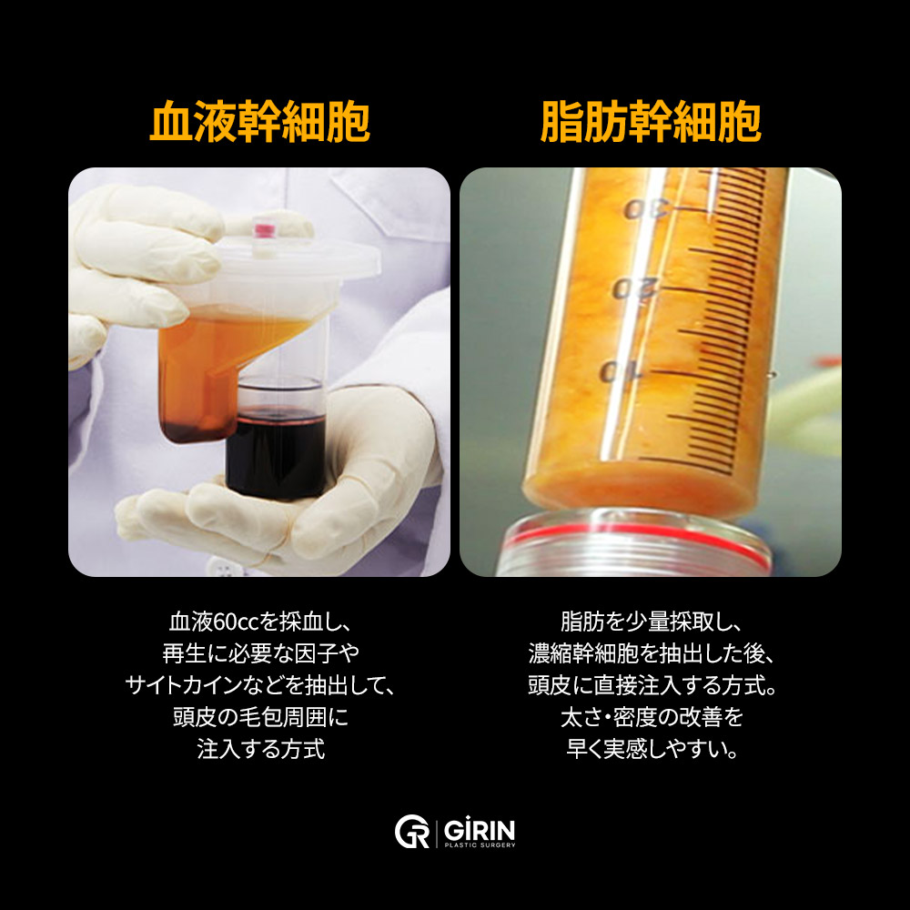 初期脱毛や予防に用いられる血液由来幹細胞治療のイメージ。