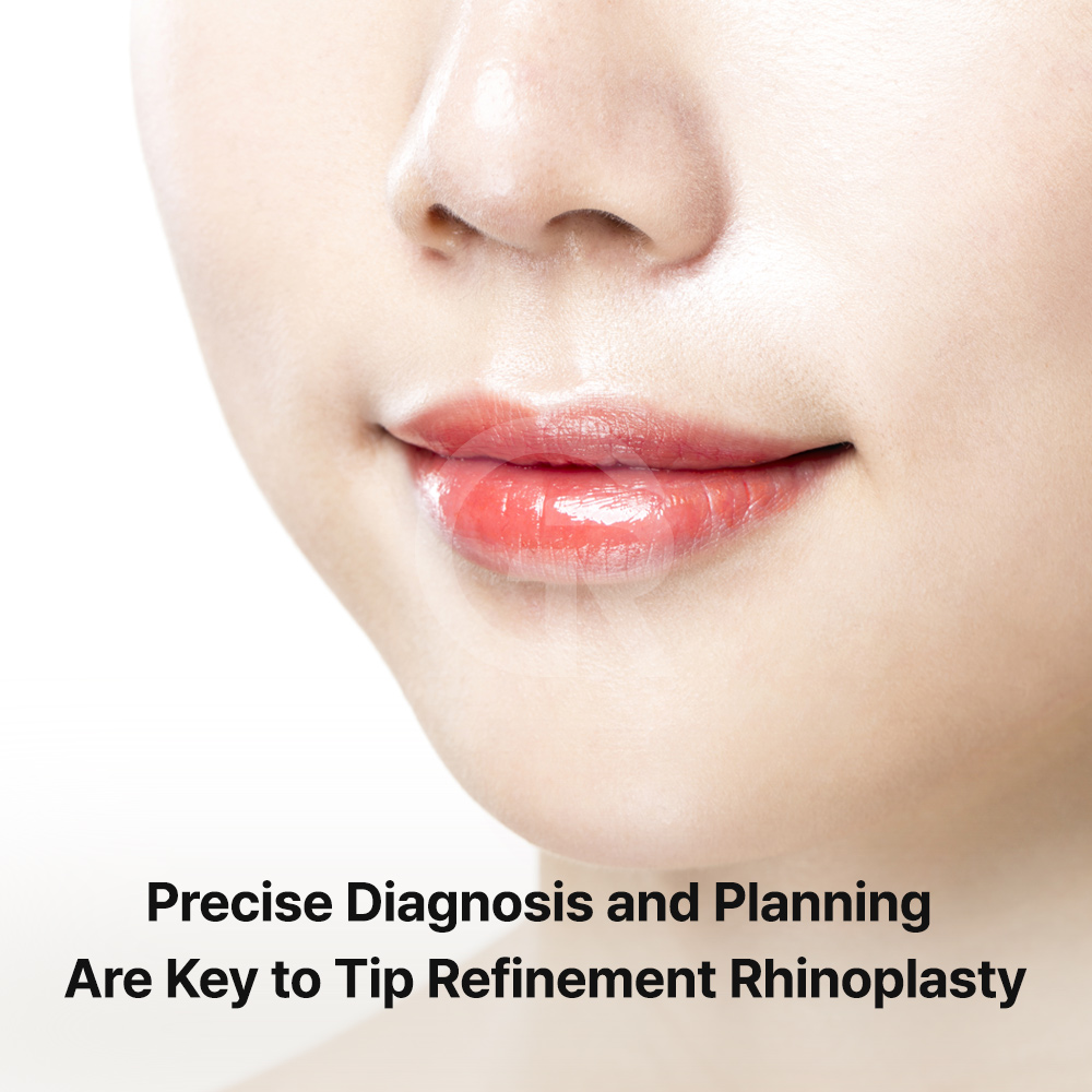 A slimmer nasal tip can be designed by reshaping and supporting the patient’s own nasal structure.