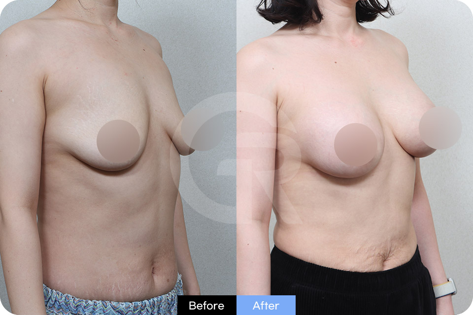 Girin Plastic Surgery Korea Breast Augmentation case 07 Half Side