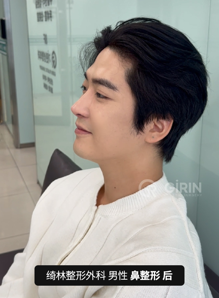 韩国男性鼻整形前后对比 — 自然直线鼻型。