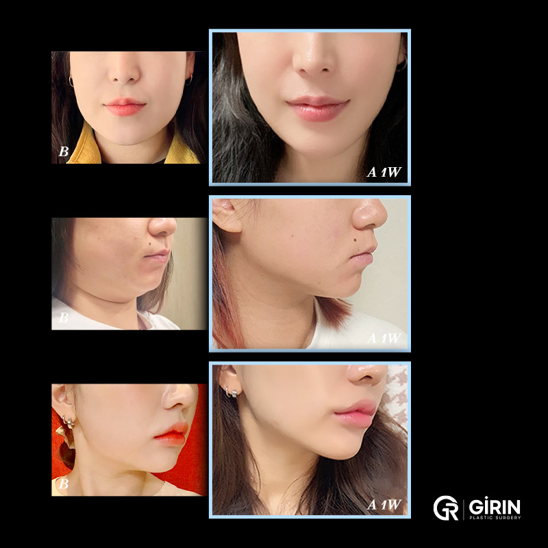 Реальные результаты после нехирургического лифтинга Girin Plastic Surgery