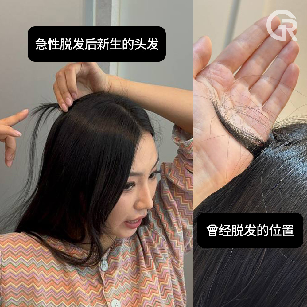 20多岁女性初期脱发症状示例