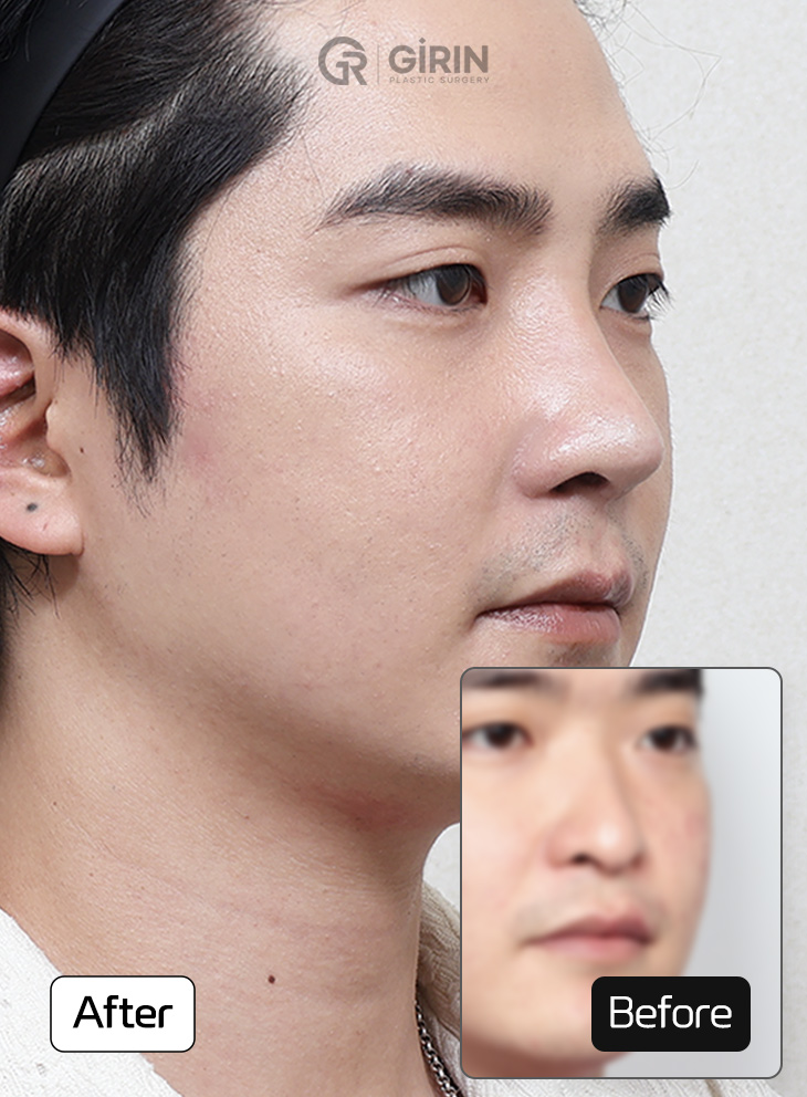 Before-and-after comparison of bulbous nasal tip improvement.
