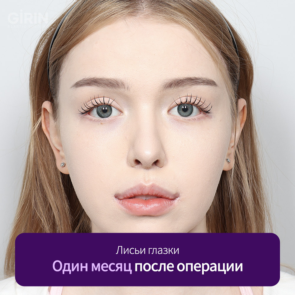 Отличия нитевого и височного лифтинга.