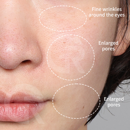 Thin skin is closely associated with collagen loss and weakened structural support.