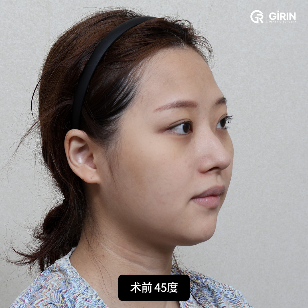 韩国SSRO颌面手术全过程