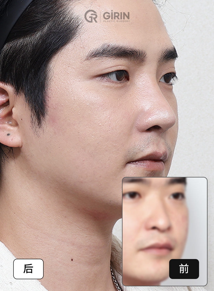 钝鼻头改善前后效果对比。