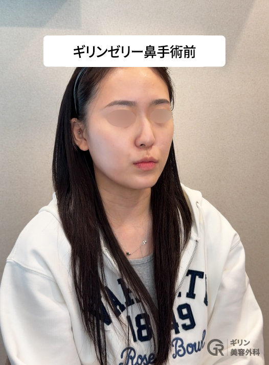 無菌環境下で軟骨を微粒子加工 ― 組織の弾力と生着率を高める工程。