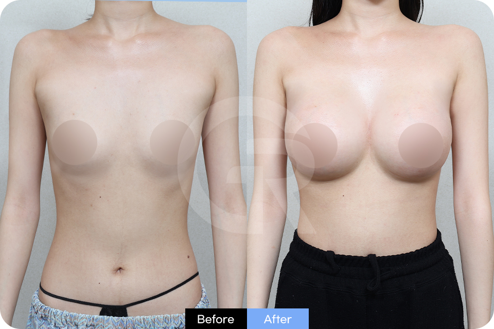 Girin Plastic Surgery Korea Breast Augmentation case 05 Front