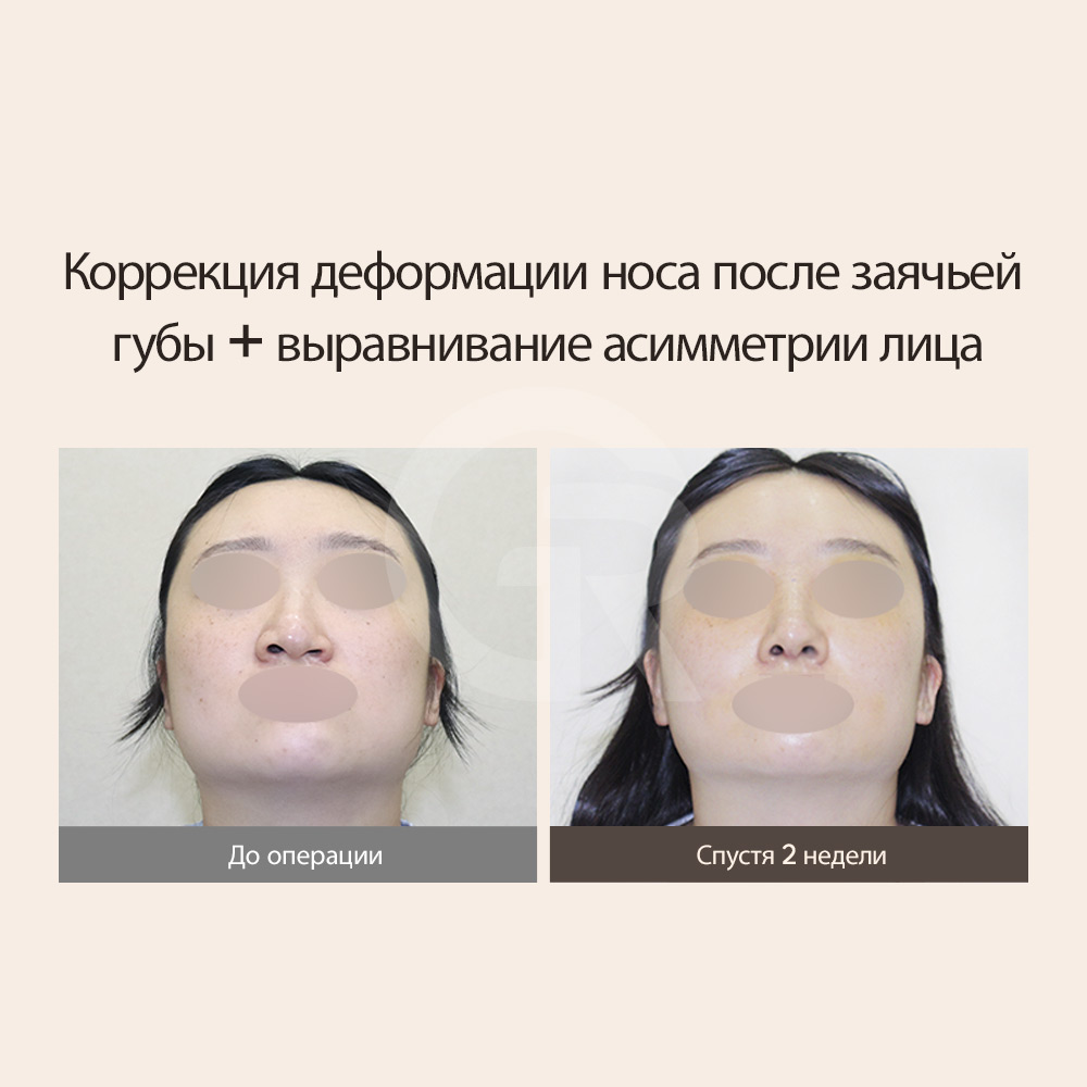 Мужская ринопластика при расщелине губы в Сеуле с акцентом на естественность и стабильность.