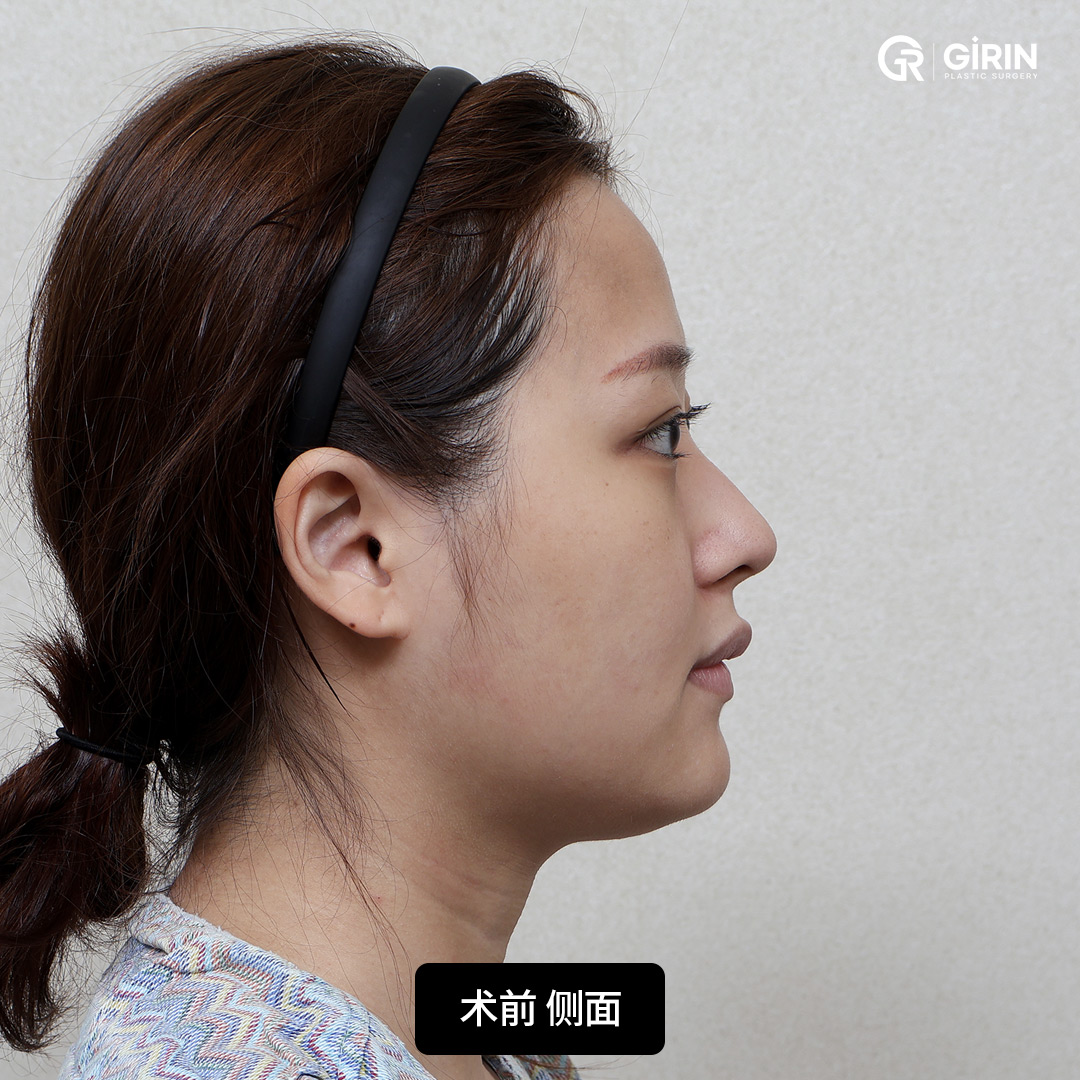 稳定而自然的术后效果