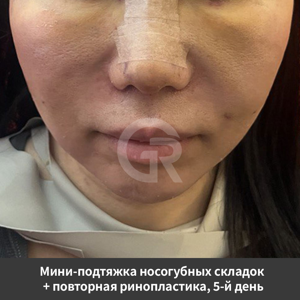 Отзыв об улучшении глубоких носогубных складок и линий марионетки в Клинике Пластической Хирургии Гирин в Корее.