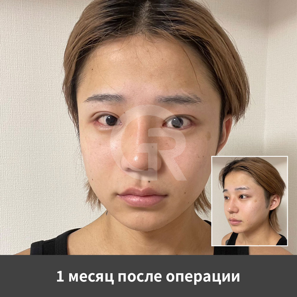 Полунаружная линия двойного века может помочь мужским пациентам сделать взгляд более четким и открытым, не утяжеляя глаза.